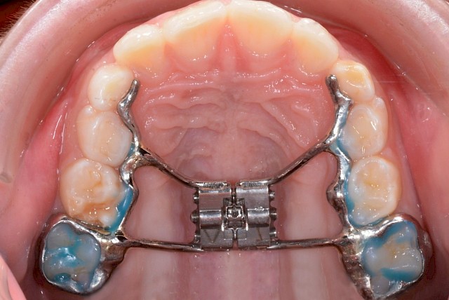 les-appareils-fixes-sandrine-gros-chirurgien-dentiste-sp-cialiste